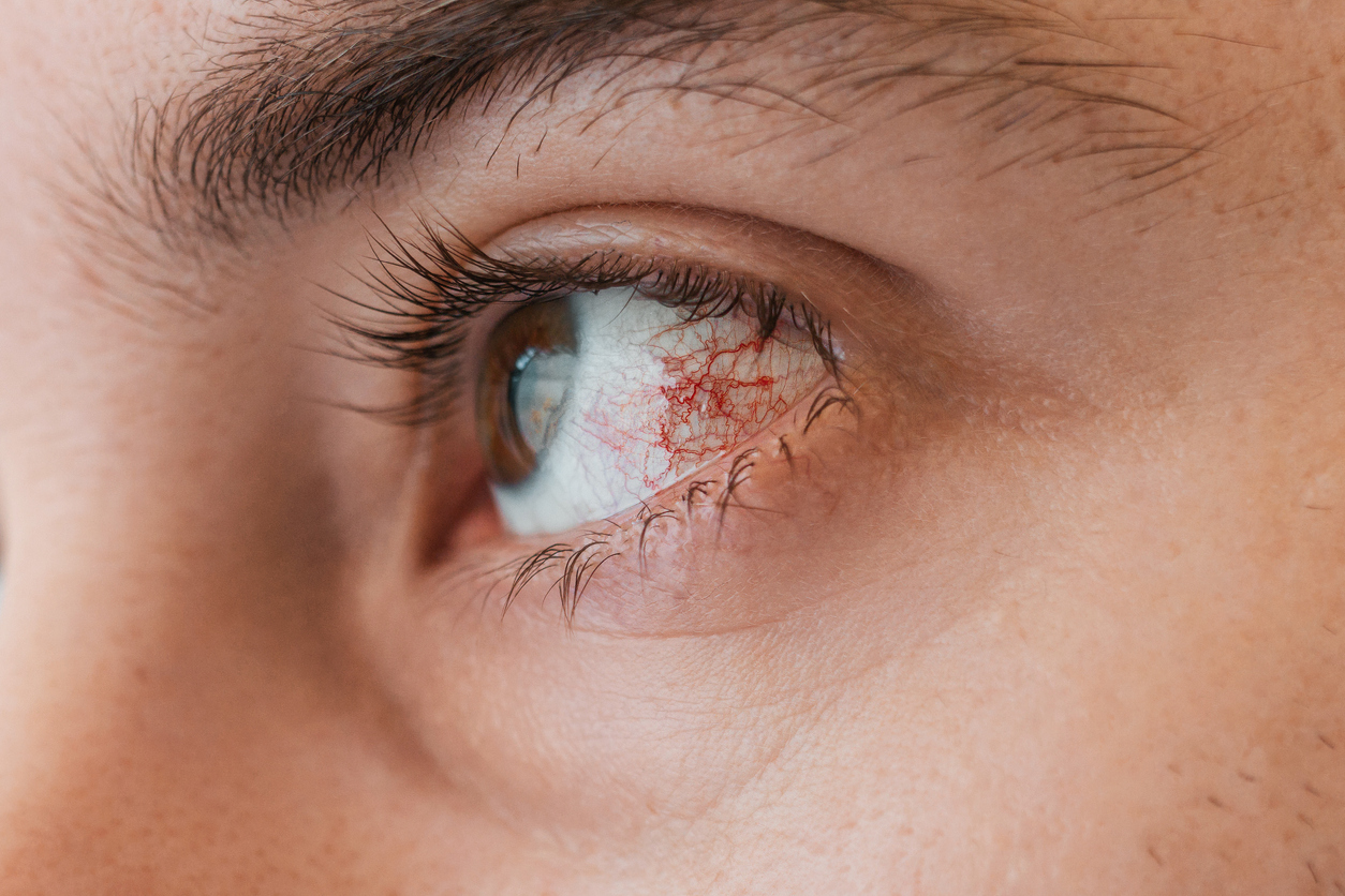Featured image for “Wegener’s Granulomatosis: An In-Depth Look at This Autoimmune Disease”