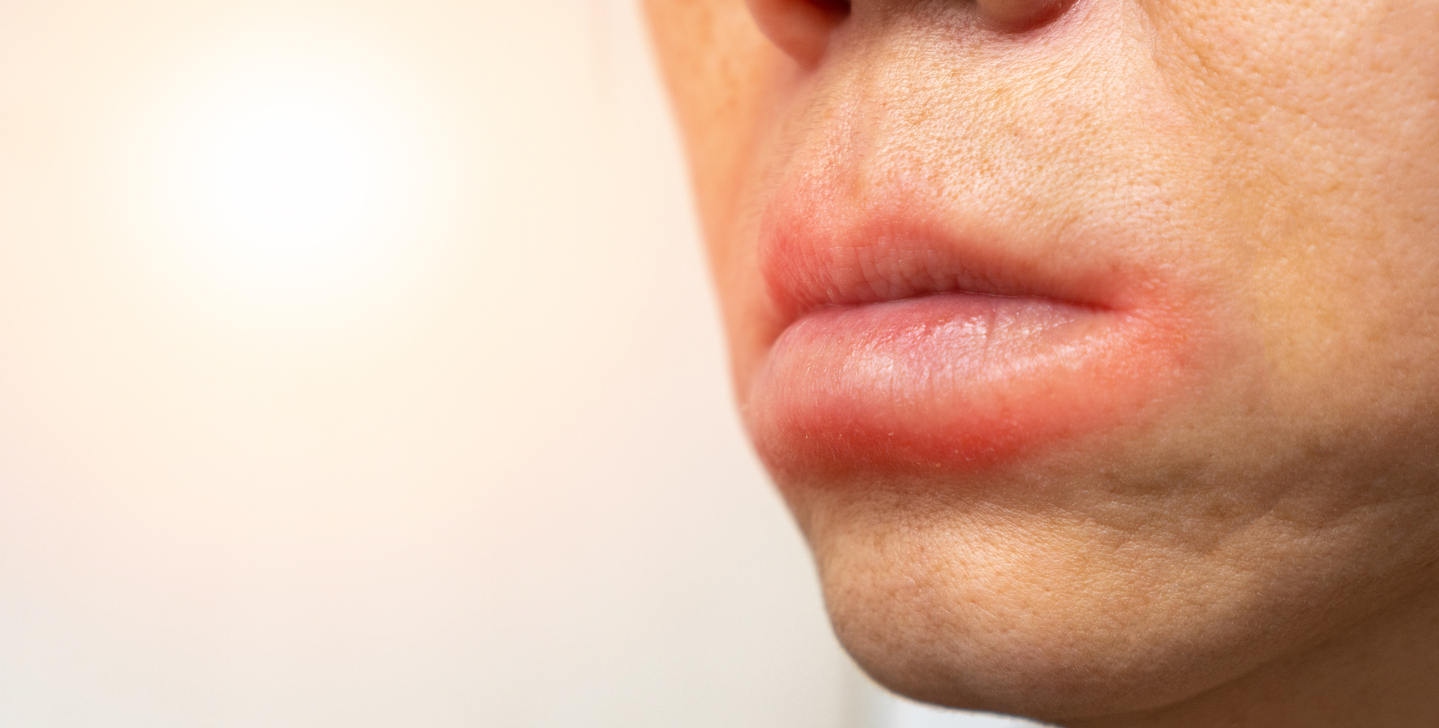 Featured image for “Sjögren’s Syndrome: Unveiling the Autoimmune Mystery”