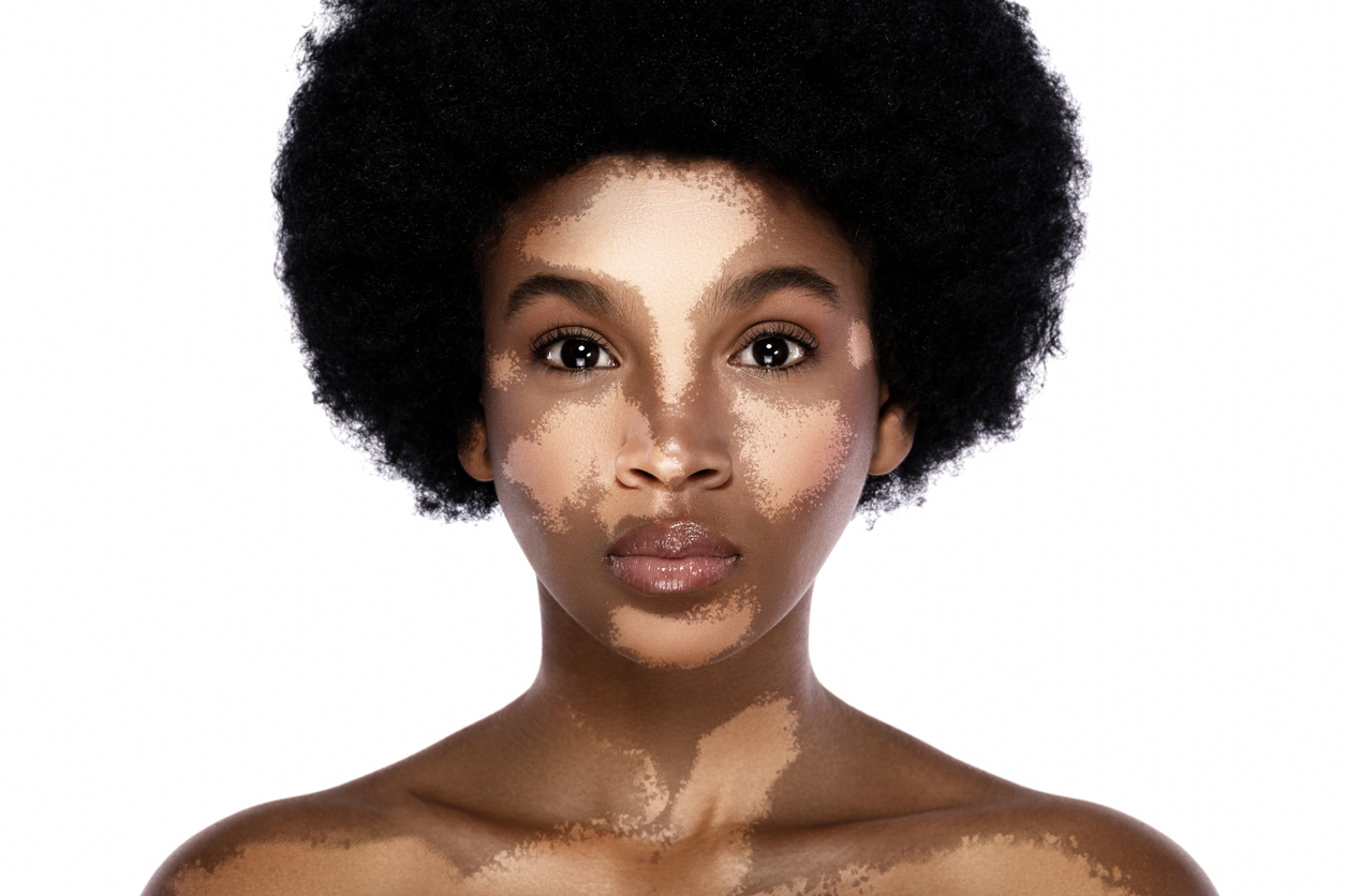 Featured image for “Vitiligo: The Autoimmune Aspect Explored”